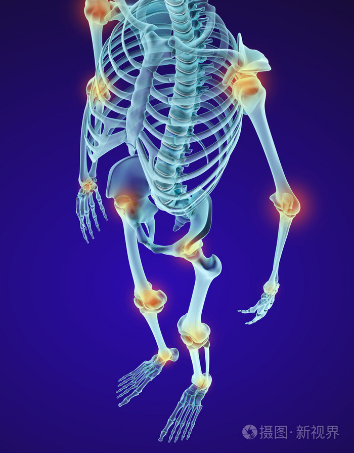 人体的骨骼和 damajed 关节x 射线视图医学上准确的 3d 图