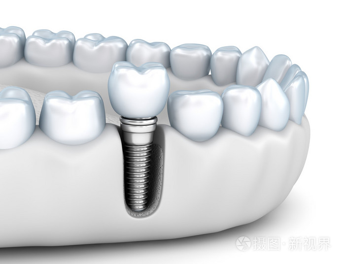 牙齿植入人体，医学上准确的 3d 图白色风格