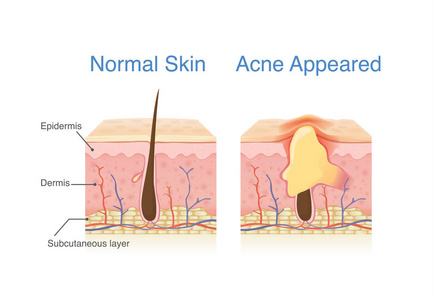 正常皮肤层和皮肤层与痤疮的区别。皮肤病学图解