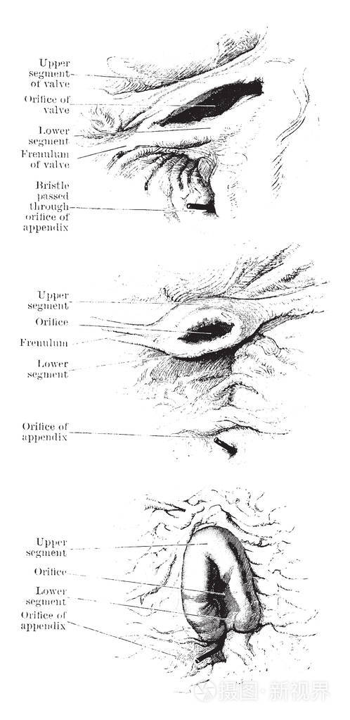 此图表示 Ileo 盲肠阀复古线图或雕刻插图