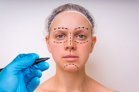 整形外科医生在病人的脸上用记号笔绘制线条