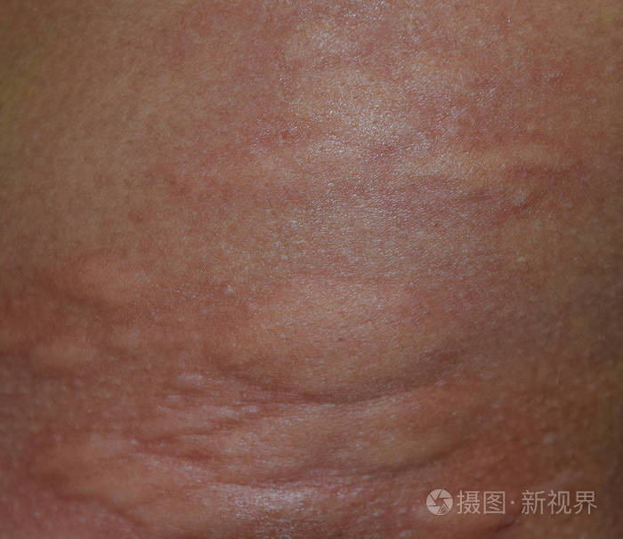过敏皮肤背部和两侧.皮肤红肿红肿的过敏反应