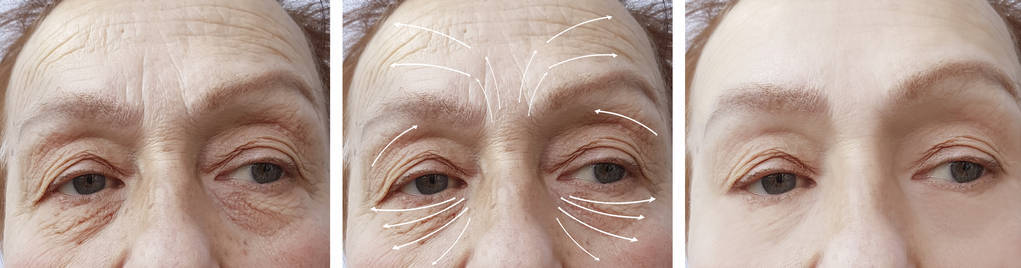 面对老年妇女皱纹纠正前后的程序箭头
