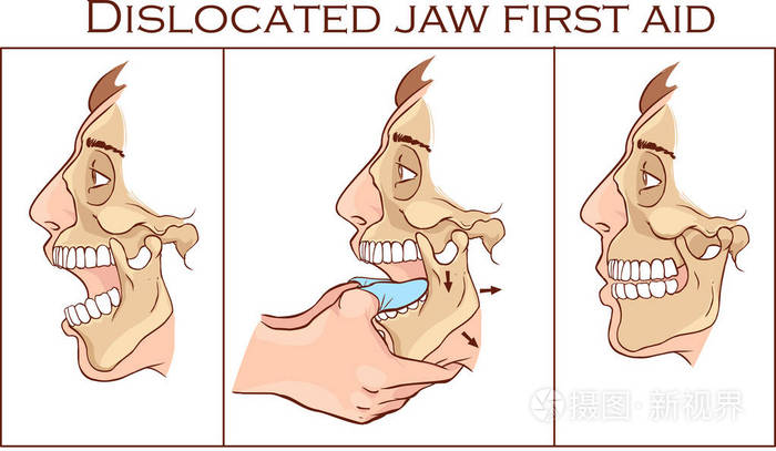 矢量图的急救脱臼的下巴