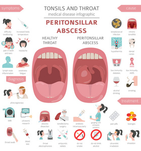 扁桃体和咽喉疾病。腹膜脓肿症状, 治疗图标集。医疗信息图设计。向量例证