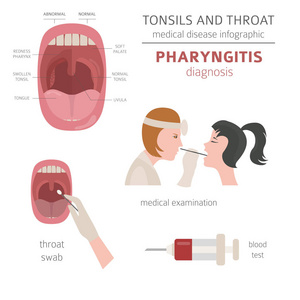 扁桃体和咽喉疾病。咽炎症状, 治疗图标集。医疗信息图设计。向量例证