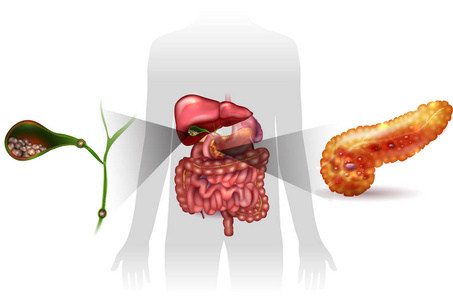 胆结石与胰腺炎