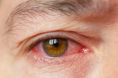 眼刺激特写镜头刺激感染的红血眼, 结膜炎照片