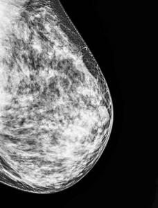 乳房 x 线钼靶摄影