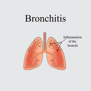 支气管炎。人肺的解剖结构。在灰色的背景上的矢量图
