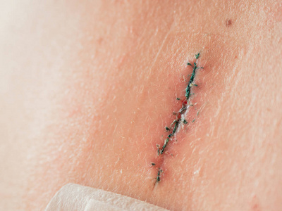 大手术手术缝合线切除后的疤痕照片.大的痣已经用手术刀手术切除.