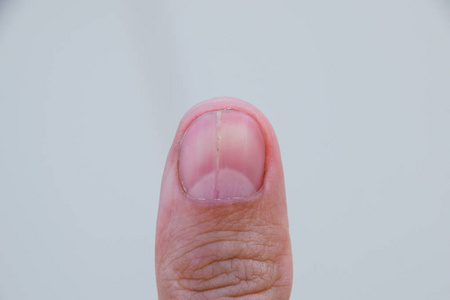 拇指上的叉钉。指甲膨胀, 外伤性病理学。钉子分成两半