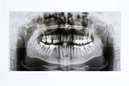 X射线的颌骨和牙齿