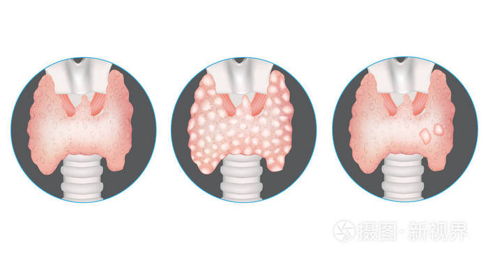 甲状腺疾病 健康的甲状腺 多结节性甲状腺肿和带结节的腺体插画 正版商用图片0tuohf 摄图新视界