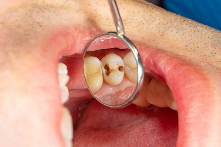 两个咀嚼侧牙的上颌骨治疗龋齿后。用橡胶坝系统感光树脂充填材料修复咀嚼面