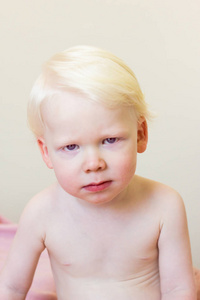 白发婴儿与白化病综合征图片
