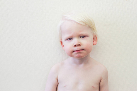 白发婴儿与白化病综合征
