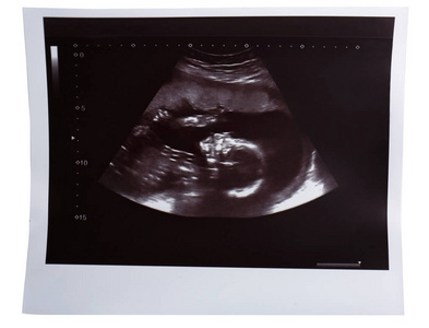 超声婴儿扫描