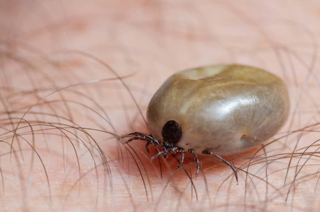 满腔热血坐在人体皮肤上的蜱虫照片