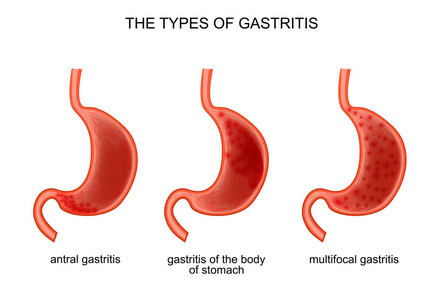 胃炎的类型