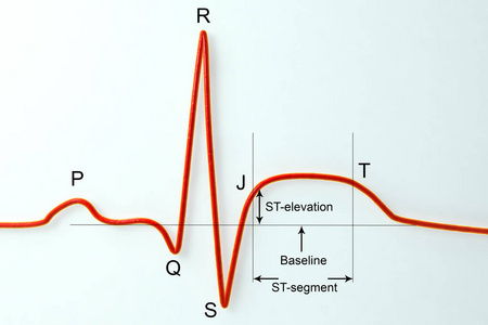 段波在心肌梗死的心电图.插图显示 st 段抬高,标记图像照片