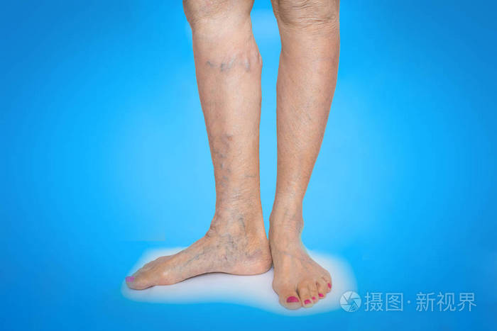 在女性的腿上静脉曲张