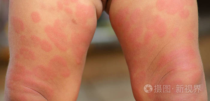 腿部婴儿皮疹, 皮炎