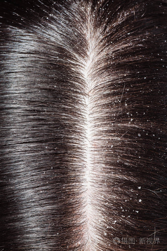 关于女人的黑头发头皮屑