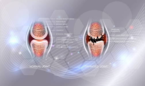 受损的关节及正常关节