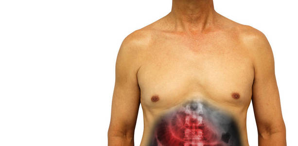结肠癌和小肠阻塞。与 x 射线显示小肠扩张由于人类腹部阻碍。孤立的背景。在左侧的空白区域