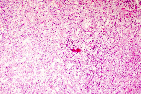 人类的大脑,轻的光学显微镜的液化性坏死照片