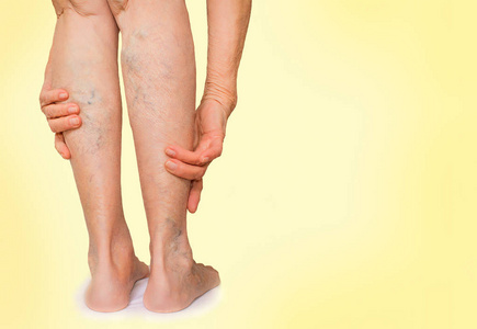 女性腿与脉曲张蜘蛛照片