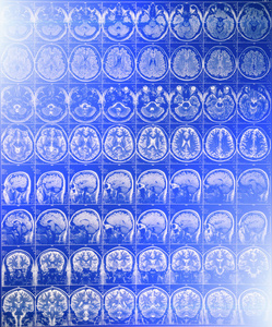头脑扫描与蓝光效应的磁共振成像或磁共振成像