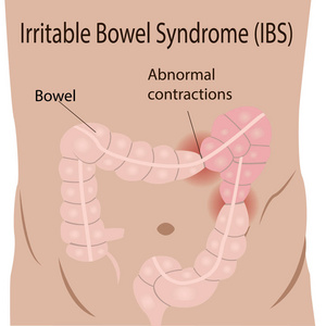 大肠肠易激综合征 Ibs