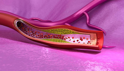 胆固醇斑块的血管,医学上准确的 3d 图照片