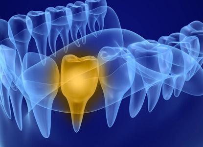 问题牙 x 射线看法。医学上精确的牙3d 例证