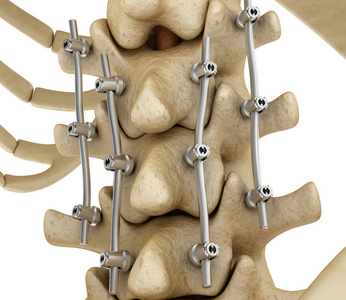 颈椎手术植入支架图片图片