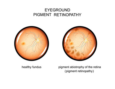 眼底。色素视网膜病变