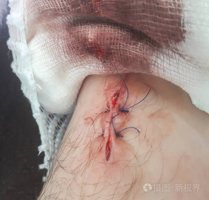 缝合腿伤.宏两个接缝