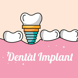 牙科种植符号图标, 口腔和牙科, 植入符号矢量图形, 一个坚实的模式在