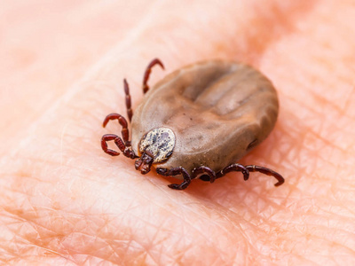 从病人手用镊子去除蜱虫寄生虫蜱虫医生从病人手用镊子去除蜱虫咬痕
