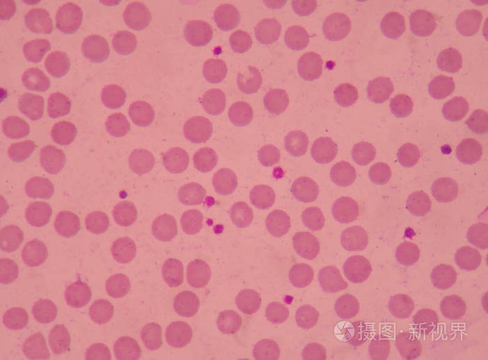 大血小板对血涂片红细胞背景的影响