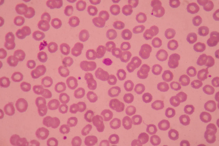 大血小板对血涂片红细胞背景的影响