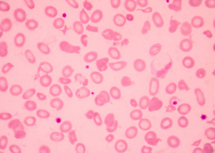 地中海贫血血涂片异常红细胞形态。医学科学概念