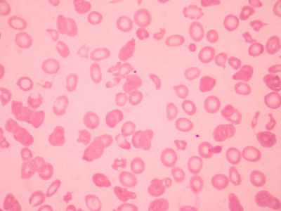 地中海贫血血涂片异常红细胞形态。医学科学概念