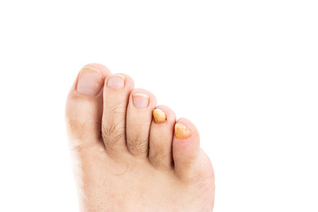 男性脚趾甲与真菌感染分离的白色背景和 copyspace