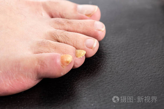 带真菌的黄色男性指甲趾甲或脚指甲趾真菌病照片 正版商用图片0up1nz 摄图新视界