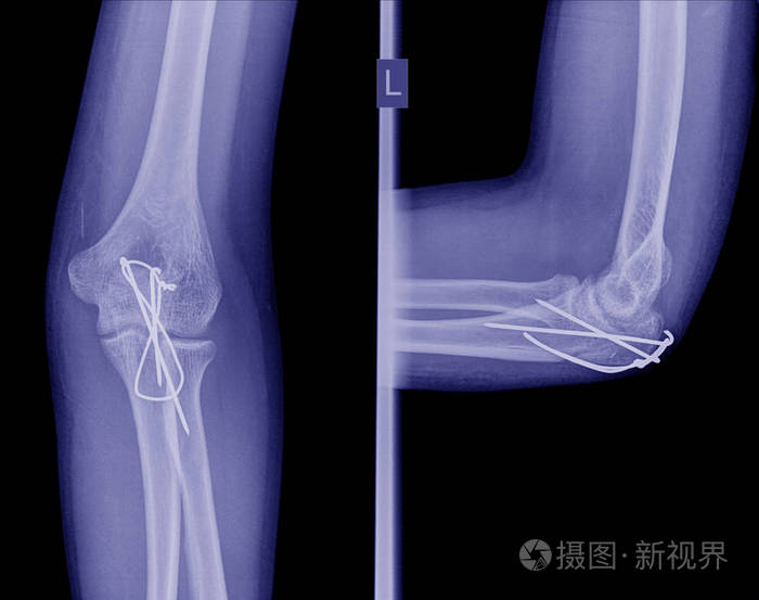 X 线术后内固定肘骨折照片 正版商用图片0up7yi 摄图新视界 X 线术后内固定肘骨折照片 正版商用图片0up7yi 摄图新视界