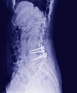 骨盆和脊柱的 X 线, 侧视后切开复位内固定与内骨骼棒, 钢板和螺钉的矫形外科医生