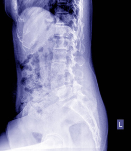 骨盆和脊柱的 X 线, 侧面视图